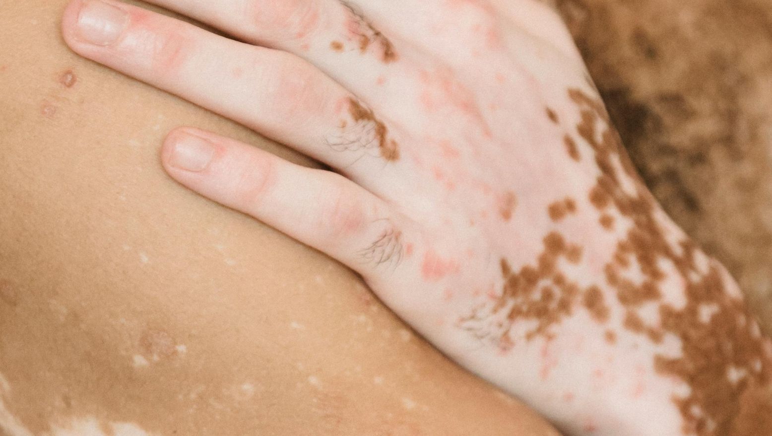 How Effective Is Vitiligo Treatment Today?