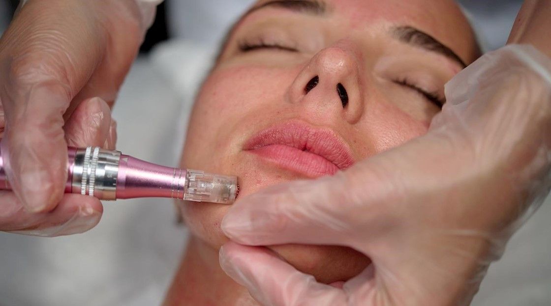 How Is Mesotherapy Different from Microneedling?