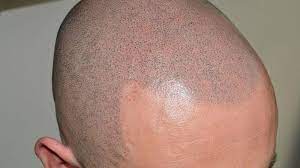 Is Hair Replacement Visible to Other People?
