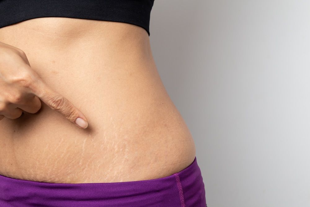 How Effective Is Mesotherapy for Stretch Marks?