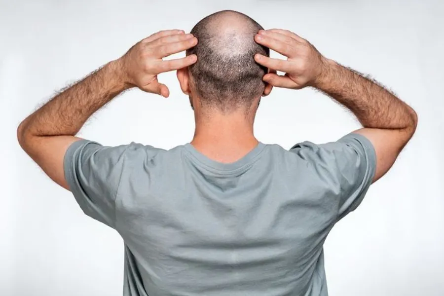 How to Estimate Hair Transplant Cost Accurately?