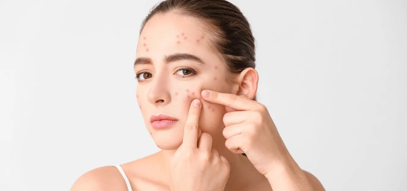 What Pimples Treatment Has the Longest Lasting Effect
