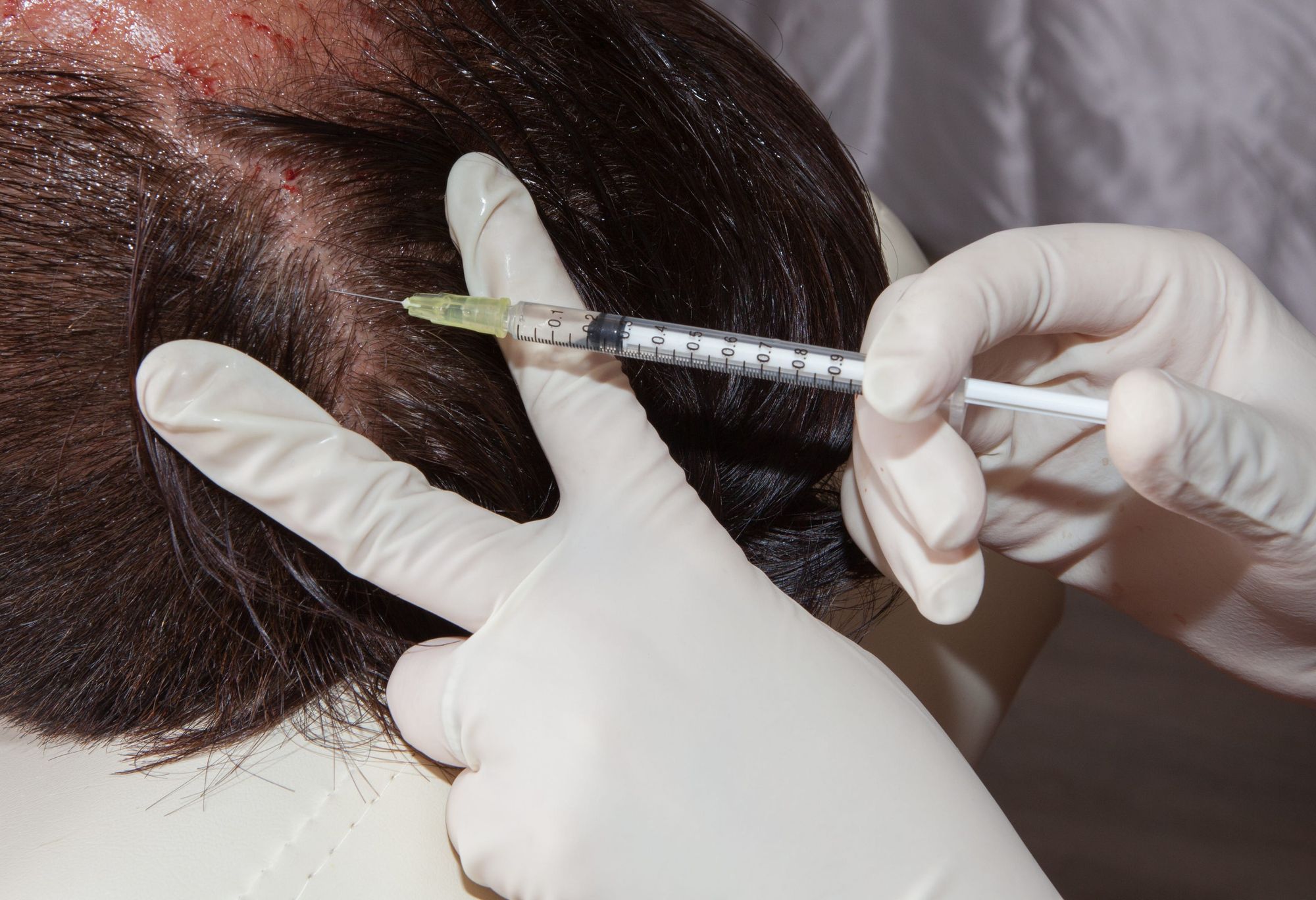 Does PRP Hair Treatment Improve Hair Density?