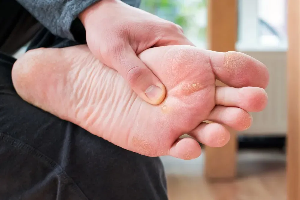 How Is Warts Removal Treatment Done by Experts?