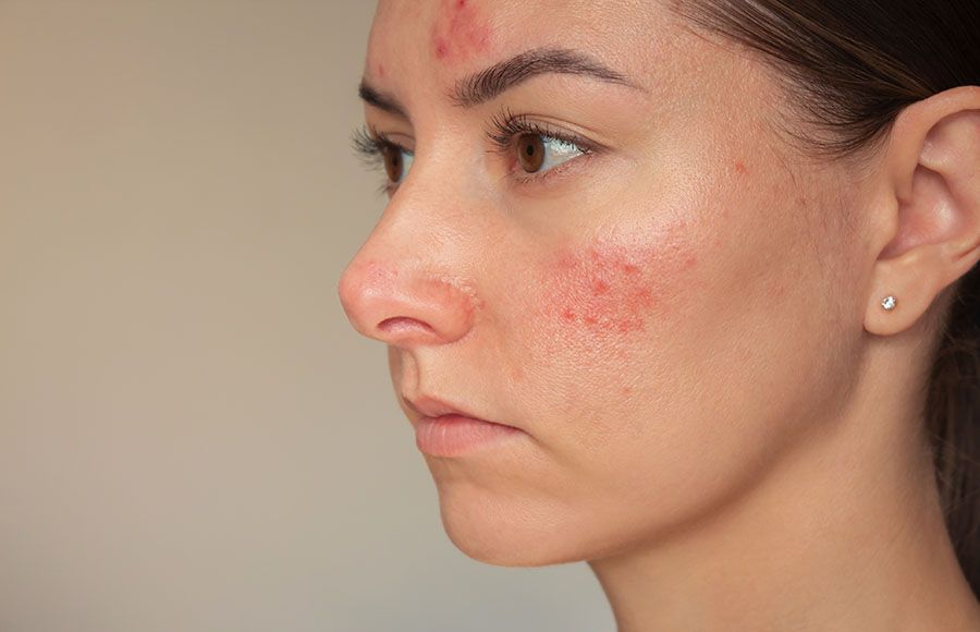 Is Rosacea Treatment Painful or Comfortable to Get?