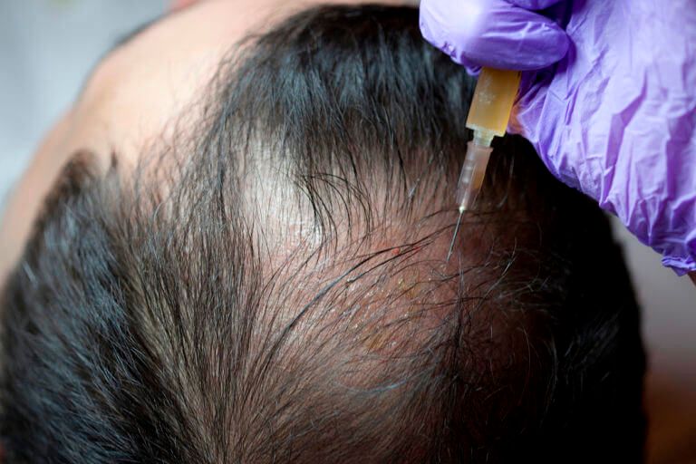 What PRP Hair Injections Cost and Include?
